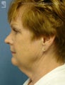 Facelift, Brow Lift & Lower Blepharoplasty