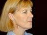 Face Lift, endosopic brow lift, eyelid lift.