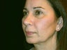 Complete Face Lift