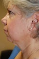 Facelift