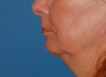 Face Lift