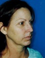 Facelift