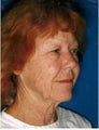 Facelift