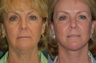 Facelift