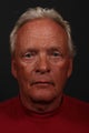 Male facial rejuvenation