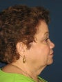 Facelift