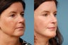 Face lift, Endoscopic Brow lift, Chin Augmentation and Upper Blepharoplasty