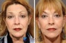 Facelift