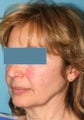 Facelift