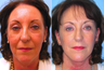 Facelift, necklift, upper & lower blepharoplasty