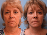 Facelift, necklift, upper & lower blepharoplasty