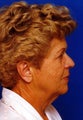 Facelift