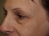 Lower Blepharoplasty