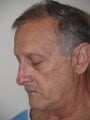 Upper and Lower Blepharoplasty