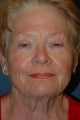 Facelift
