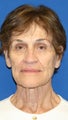 Facelift, Browlift, & Skin Pinch