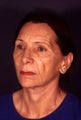Facelift