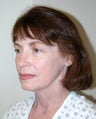 Facelift