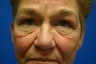 Facelift