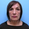 Facelift