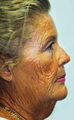 Facelift
