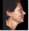 Facelift