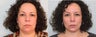 Facelift