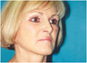 Facelift