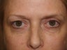 Before and After upper and lower lid Blepharoplasty