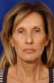 Multiple facial plastic surgery procedures