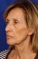 Multiple facial cosmetic surgery procedures
