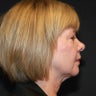 Facelift + Neck Lift + Eyelid Lift (Blepharoplasty)