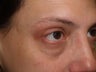 Before and After Lower Lid Blepharoplasty