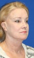 Facelift with Extended Necklift, Browlift, Peri-orbital Fat Transfer, and Skin Pinch