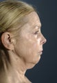 Facelift