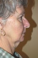 Facelift