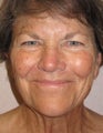 Facelift