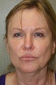 Facelift, Liposuction of the Neck, Upper Eyelid Blepharoplasty, Juvederm injections into the upper and lower lips, tip rhinopla