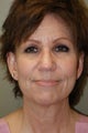 facelift with Liposuction of the Neck