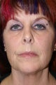 Facelift, Liposuction of the Neck, Facial Peel