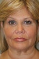 Facelift, Liposuction of the Neck, Upper Eyelid Lift