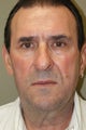 Facelift, Liposuction of the Neck, Fat Grafting to the Midface and Nasolabial, DOT Lazer Therapy