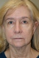 Facelift, Liposuction of the Neck, Browlift, DOT Laser Therapy