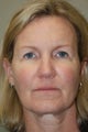 Facelift, Upper Eyelid Biepharoplasty, DOT Laser Therapy