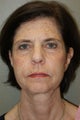 Facelift, Liposuctin of the Neck, Browlift, Upper and Lower Eyelid Biepharoplasty, Fat Grafting to Mid Face Regions, DOT