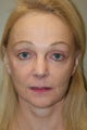 Facelift, Upper and Lower Lip Augmentation, Browlift, DOT Laser Therapy