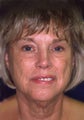 Facelift