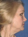 Facelift