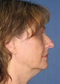 Facelift