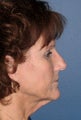 Facelift